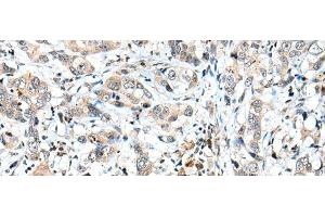 Immunohistochemistry of paraffin-embedded Human breast cancer tissue using SPCS2 Polyclonal Antibody at dilution of 1:40(x200) (SPCS2 抗体)