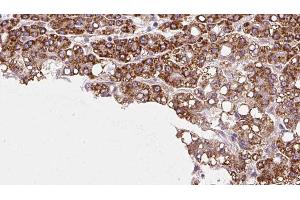 ABIN6272977 at 1/100 staining Human liver cancer tissue by IHC-P. (PTPRU 抗体  (Internal Region))