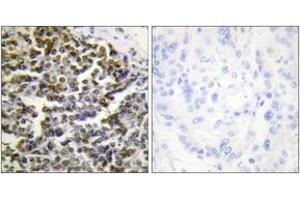 Immunohistochemistry analysis of paraffin-embedded human lung carcinoma tissue, using TCOF1 Antibody. (TCOF1 抗体  (AA 41-90))