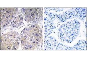 Immunohistochemistry analysis of paraffin-embedded human liver carcinoma tissue, using SLC27A5 Antibody. (SLC27A5 抗体  (AA 481-530))
