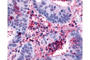 Anti-HRH4 / Histamine H4 Receptor antibody IHC of human Colon, Carcinoma and Inflammatory Cells. (HRH4 抗体  (Cytoplasmic Domain))