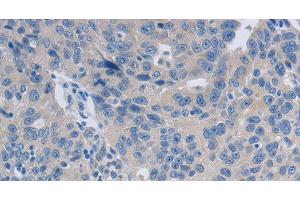 Immunohistochemistry of paraffin-embedded Human ovarian cancer tissue using GRIN1 Polyclonal Antibody at dilution 1:50 (GRIN1/NMDAR1 抗体)