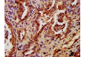 IHC image of ABIN7165707 diluted at 1:700 and staining in paraffin-embedded human lung cancer performed on a Leica BondTM system. (PKC eta 抗体  (AA 1-678))