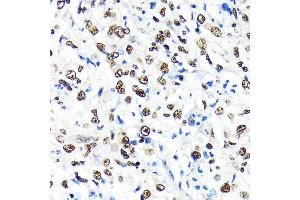 Immunohistochemistry of paraffin-embedded human liver cancer using CRM1/XPO1 antibody (ABIN7267067) at dilution of 1:100 (40x lens). (XPO1 抗体)