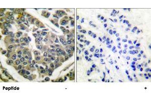 Immunohistochemical analysis of paraffin-embedded human breast carcinoma tissue using COL4A1 polyclonal antibody . (COL4A1 抗体  (AA 31-70))