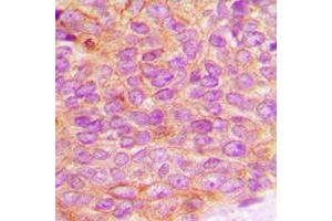 Immunohistochemical analysis of JAK2 (pY1007) staining in human breast cancer formalin fixed paraffin embedded tissue section. (JAK2 抗体  (C-Term, pTyr1007))