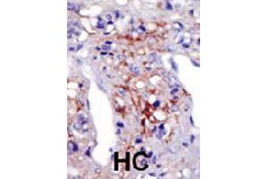 Formalin-fixed and paraffin-embedded human hepatocellular carcinoma tissue reacted with PIP5K1C polyclonal antibody  , which was peroxidase-conjugated to the secondary antibody, followed by AEC staining. (PIP5K1C 抗体  (N-Term))