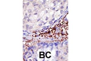 Formalin-fixed and paraffin-embedded human cancer tissue reacted with the primary antibody, which was peroxidase-conjugated to the secondary antibody, followed by DAB staining. (RNF216 抗体  (C-Term))