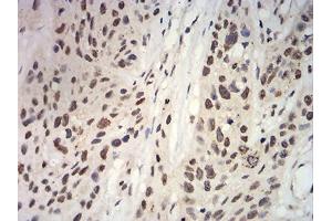 Immunohistochemical analysis of paraffin-embedded esophageal cancer tissues using ANAPC10 mouse mAb with DAB staining.