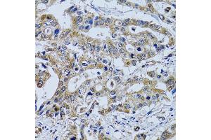 Immunohistochemistry of paraffin-embedded human colon carcinoma using TPPP3 antibody. (TPPP3 抗体)