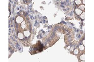 ABIN6267374 at 1/200 staining human colon cancer tissue sections by IHC-P.