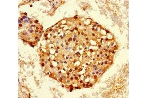 Immunohistochemistry of paraffin-embedded human breast cancer using ABIN7155138 at dilution of 1:100 (HNRNPA2B1 抗体  (AA 1-249))