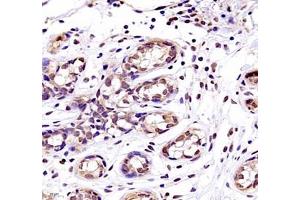 Immunohistochemistry of paraffin embedded human breast cancer using TYW1B (ABIN7076025) at dilution of 1: 700 (400x lens)