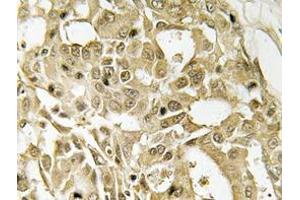 Immunohistochemistry analyzes of Catenin-β antibody in paraffin-embedded human breast carcinoma tissue. (CTNNB1 抗体)