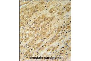 DKC1 Antibody immunohistochemistry analysis in formalin fixed and paraffin embedded human prostate carcinoma followed by peroxidase conjugation of the secondary antibody and DAB staining. (DKC1 抗体  (AA 185-213))