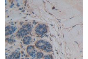 Detection of THBS1 in Human Breast cancer Tissue using Polyclonal Antibody to Thrombospondin 1 (THBS1) (Thrombospondin 1 抗体  (AA 24-221))