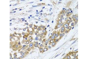 Immunohistochemistry of paraffin-embedded Human colon carcinoma using PEX14 Polyclonal Antibody at dilution of 1:100 (40x lens). (PEX14 抗体)