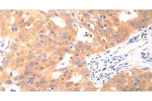 Immunohistochemistry of paraffin-embedded Human ovarian cancer using CAPNS1 Polyclonal Antibody at dilution of 1:60 (Calpain S1 抗体)