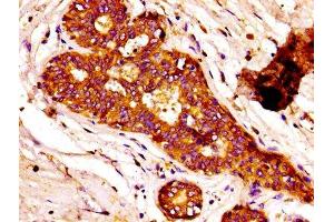 IHC image of ABIN7152610 diluted at 1:100 and staining in paraffin-embedded human breast cancer performed on a Leica BondTM system. (Fatty Acid Synthase 抗体  (AA 2155-2495))