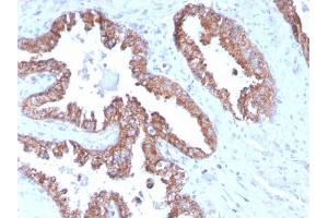 Formalin-fixed, paraffin-embedded human Prostate Carcinoma stained with PMEPA1 Mouse Monoclonal Antibody (PMEPA1/2696).
