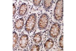 Immunohistochemical analysis of IL-12B staining in human colon cancer formalin fixed paraffin embedded tissue section. (IL12B 抗体  (C-Term))