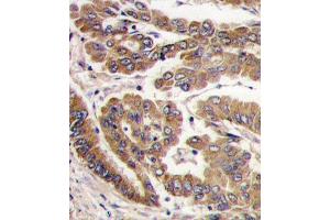 Formalin-fixed and paraffin-embedded human lung carcinoma tissue reacted with PKC zeta antibody (N-term), which was peroxidase-conjugated to the secondary antibody, followed by DAB staining. (PKC zeta 抗体  (N-Term))