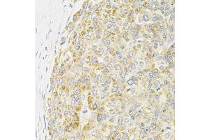 Immunohistochemistry of paraffin-embedded human liver cancer using PPP1CA antibody (ABIN6290760) at dilution of 1:100 (40x lens). (PPP1CA 抗体)