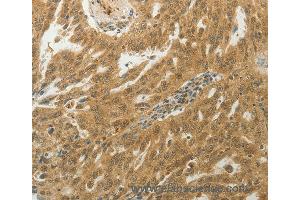 Immunohistochemistry of Human ovarian cancer using MYSM1 Polyclonal Antibody at dilution of 1:50