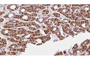 ABIN6272414 at 1/100 staining Human liver cancer tissue by IHC-P. (RHOG 抗体  (Internal Region))