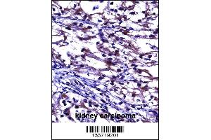 TNFRSF11B Antibody immunohistochemistry analysis in formalin fixed and paraffin embedded human kidney carcinoma followed by peroxidase conjugation of the secondary antibody and DAB staining. (Osteoprotegerin 抗体  (AA 243-271))