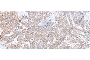 Immunohistochemistry of paraffin-embedded Human liver cancer tissue using PLGLB2 Polyclonal Antibody at dilution of 1:65(x200) (PLGLB2 抗体)