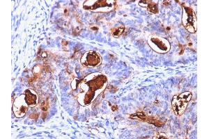 Formalin-fixed, paraffin-embedded human Colon Carcinoma stained with CEA Mouse Monoclonal Antibody (C66/1260). (CEACAM5 抗体)