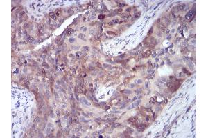 Immunohistochemical analysis of paraffin-embedded human cervical cancer tissues using SELL mouse mAb with DAB staining.