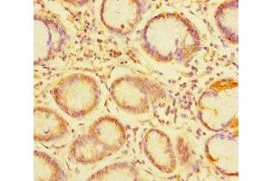 Immunohistochemistry of paraffin-embedded human gastric cancer using ABIN7173760 at dilution of 1:100 (TDRD1 抗体  (AA 12-314))