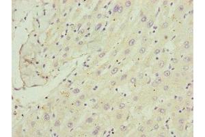 Immunohistochemistry of paraffin-embedded human liver cancer using ABIN7148370 at dilution of 1:100 (C8B 抗体  (AA 55-350))