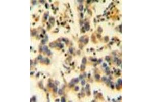 Immunohistochemistry analysis in formalin fixed and paraffin embedded human testis carcinoma reacted with KIAA0090 Antibody (C-term) followed which was peroxidase conjugated to the secondary antibody and followed by DAB staining.
