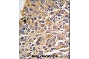 Formalin-fixed and paraffin-embedded human lung carcinoma tissue reacted with RIP3 (RIPK3) antibody (N-term) (ABIN391272 and ABIN2841322) , which was peroxidase-conjugated to the secondary antibody, followed by DAB staining. (RIPK3 抗体  (N-Term))