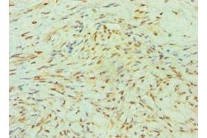 Immunohistochemistry of paraffin-embedded human breast cancer using ABIN7155524 at dilution of 1:100 (SMYD3 抗体  (AA 199-428))