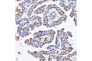Immunohistochemistry of paraffin-embedded Human thyroid cancer using IL23R Rabbit pAb (ABIN3022245, ABIN3022246, ABIN3022247, ABIN1513088 and ABIN6218691) at dilution of 1:100 (40x lens). (IL23R 抗体  (AA 405-629))