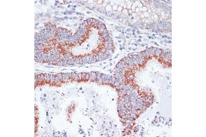 Immunohistochemistry of paraffin-embedded human colon carcinoma using CD71/Transferrin Receptor antibody (ABIN6131555, ABIN6149065, ABIN6149066 and ABIN6221572) at dilution of 1:100 (40x lens). (Transferrin Receptor 抗体  (AA 1-140))