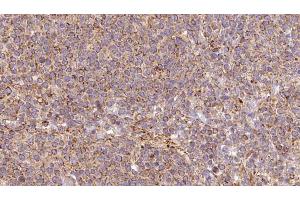 ABIN6273194 at 1/100 staining Human lymph cancer tissue by IHC-P. (ARL8B 抗体  (Internal Region))