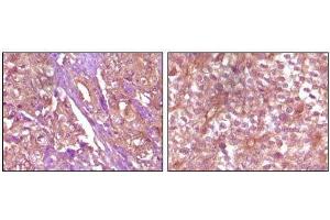 Immunohistochemical analysis of paraffin-embedded Human pancreas carcinoma (left) and breast carcinoma (right) tissue, showing membrane and cytoplasmic (pancreas carcinoma) localization, membrane (breast carcinoma) localization using EphB4 mouse mAb with DAB staining. (EPH Receptor B4 抗体)