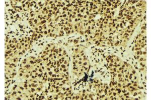 ABIN6268656 at 1/100 staining Human breast cancer tissue by IHC-P. (XBP1 抗体  (C-Term))