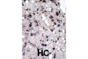 Formalin-fixed and paraffin-embedded human hepatocellular carcinoma tissue reacted with HK2 polyclonal antibody  , which was peroxidase-conjugated to the secondary antibody, followed by DAB staining. (Hexokinase 2 抗体  (Internal Region))