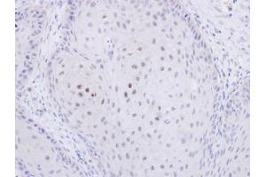 IHC-P Image Immunohistochemical analysis of paraffin-embedded Cal27 xenograft, using C20orf11, antibody at 1:500 dilution. (GID8/C20orf11 抗体  (Center))