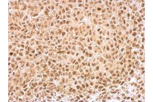 IHC-P Image KLF5 antibody detects KLF5 protein at nucleus on HeLa xenograft by immunohistochemical analysis. (KLF5 抗体)