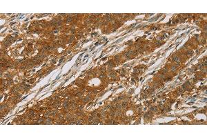 Immunohistochemistry of paraffin-embedded Human gasrtic cancer tissue using CYP27A1 Polyclonal Antibody at dilution 1:50 (CYP27A1 抗体)