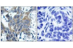 Immunohistochemical analysis of paraffin-embedded human breast carcinoma tissue, using β-Catenin (phospho-Ser33) antibody (E011218). (beta Catenin 抗体  (pSer33))