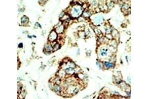 IHC analysis of FFPE human breast carcinoma tissue stained with the EphA2 antibody (EPH Receptor A2 抗体  (AA 30-60))