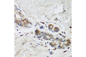 Immunohistochemistry of paraffin-embedded human breast cancer using ISG15 Antibody.